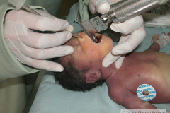 intubacion-nasotraqueal-013