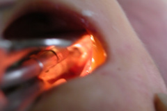 intubacion-orotraqueal-002