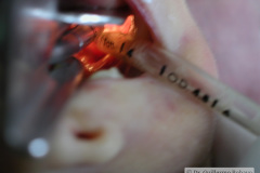 intubacion-orotraqueal-003