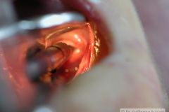 intubacion-orotraqueal-004
