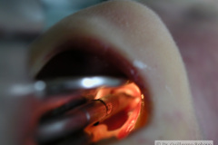 intubacion-orotraqueal-005
