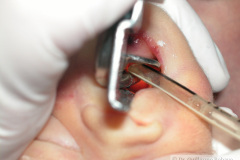 intubacion-orotraqueal-007