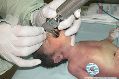 intubacion-orotraqueal-008
