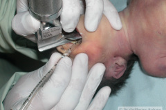 intubacion-orotraqueal-009