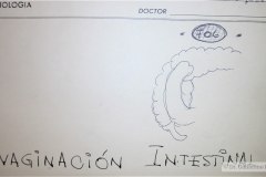 invaginacion-intestinal-colon-por-enema-1984-003
