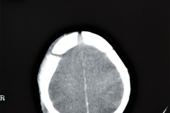 isquemia-cerebral-difusa-edema-cerebral-1995-005