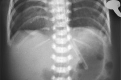 ivemark-heterotaxia-isomerismo-higado-barra-dextrocardia-2003-000