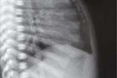 ivemark-heterotaxia-isomerismo-higado-barra-dextrocardia-2003-001