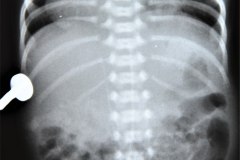 ivemark-heterotaxia-isomerismo-higado-barra-dextrocardia-2003-002