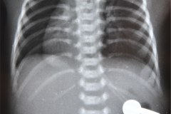 ivemark-heterotaxia-isomerismo-higado-barra-dextrocardia-2003-003