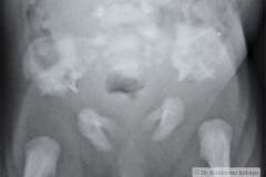 jeune-displasia-toracica-asfixiante-pelvis-acetabulo-tridente-000