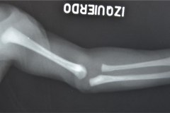 kippel-trenaunay-weber-angio-osteo-hipertrofico-1983-004