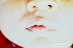 labio-hendido-der-postop-000