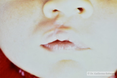 labio-hendido-der-postop-001