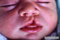 labio-hendido-izq-y-postop-000