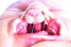 labio-y-paladar-hendidos-bil-criptorquidia-bil-003