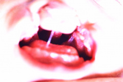 labio-y-paladar-hendidos-bil-criptorquidia-bil-005