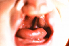 labio-y-paladar-hendidos-bil-y-postop-2005-006