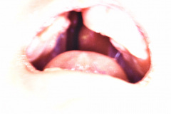 labio-y-paladar-hendidos-der-posop-2d-y-1m-001