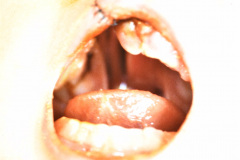 labio-y-paladar-hendidos-der-posop-2d-y-1m-005