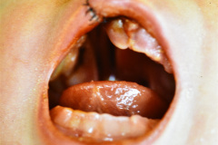 labio-y-paladar-hendidos-der-posop-2d-y-1m-009