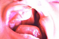 labio-y-paladar-hendidos-izq-2001-001