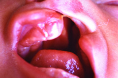 labio-y-paladar-hendidos-izq-2001-003