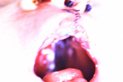 labio-y-paladar-hendidos-izq-y-postop-001