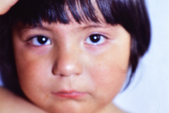 lawrence-moon-bidel-adipogenital-retinitis-pigmentosa-obesidad-hipogonadismo-hipodactilia-005