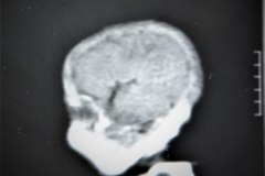 leigh-encefalopatia-necrotizante-subaguda-infantil-1991-020