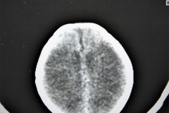 leigh-encefalopatia-necrotizante-subaguda-infantil-1991-027