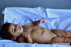 lenz-microftalmia-bil-genitales-ambiguos-hipospadias-perineal-003