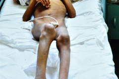 leucemia-1981-000