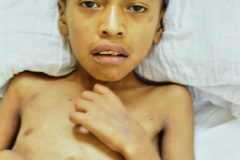 leucemia-1981-002