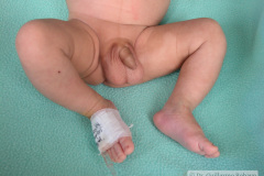 leucemia-linfocitica-aguda-1m-9d-h-luisa-fernanda-donato-franco-2005_09_05-004