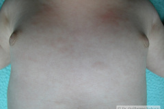 leucemia-linfocitica-aguda-1m-9d-h-luisa-fernanda-donato-franco-2005_09_05-014