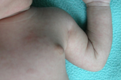 leucemia-linfocitica-aguda-1m-9d-h-luisa-fernanda-donato-franco-2005_09_05-015