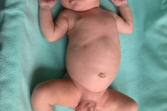leucemia-linfocitica-aguda-1m-9d-h-luisa-fernanda-donato-franco-2005_09_05-016