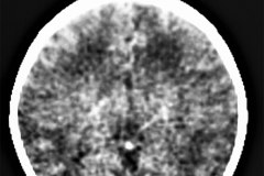 leucoencefalomalacia-1991-000