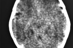 leucoencefalomalacia-1991-001
