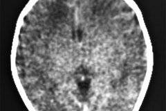 leucoencefalomalacia-1991-002