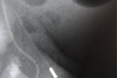 linea-arterial-femoral-izq-con-yelco-1996-04-16-h.-flor-parra-000