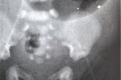 linea-arterial-femoral-izq-con-yelco-1996-04-16-h.-flor-parra-001