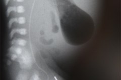 linea-arterial-femoral-izq-con-yelco-1996-04-16-h.-flor-parra-002