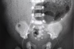 linea-arterial-femoral-izq-con-yelco-1996-04-16-h.-flor-parra-003