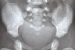 linea-grasa-prevesical-000