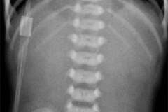 linfangiectasia-intestinal-ascitis-quilosa-001