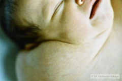 linfangio-hemangioma-higroma-quistico-cervical-der-transiluminacion-001