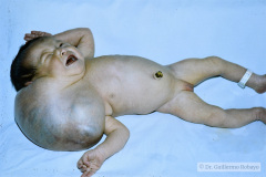 linfangio-hemangioma-higroma-quistico-cervical-der-transiluminacion-002
