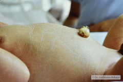 linfangio-hemangioma-higroma-quistico-cervical-der-transiluminacion-007
